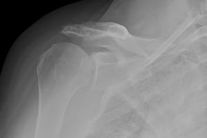 x-ray before surgery demonstrating shoulder arthritis associated with an irreparable rotator cuff tear
