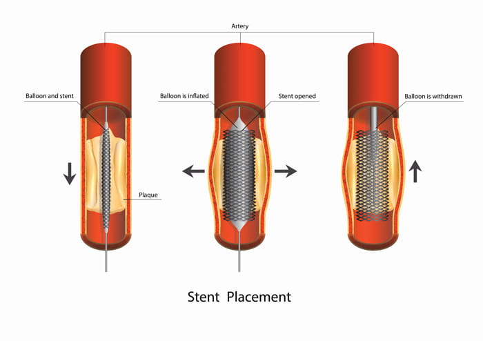 Heart Stent Procedure Diagram