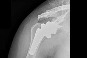 x-ray after surgery demonstrating a reverse total shoulder replacement