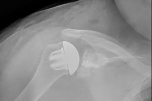 x-ray after surgery demonstrating a 'stemless' shoulder replacement