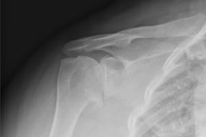 x-ray before surgery demonstrating end stage 'bone on bone' arthritis of the shoulder.