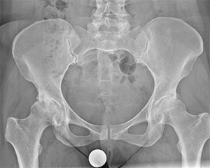 hip x-ray 