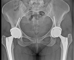 hip x-ray 2 