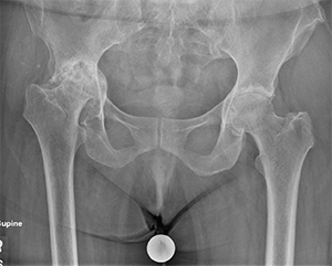 hip x-ray  3