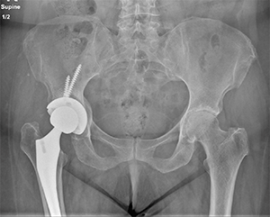 hip x-ray 4 