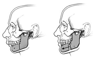 Lower Jaw Surgery