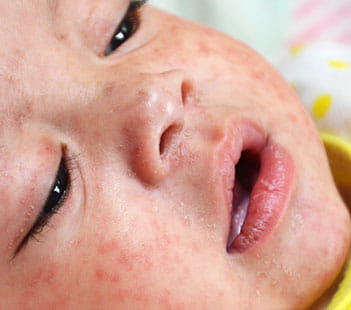 Denver Health Child with Measles
