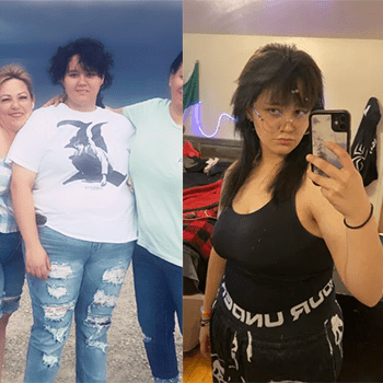 Jade Loya Adolescent Bariatric Surgery Denver Health Before and After