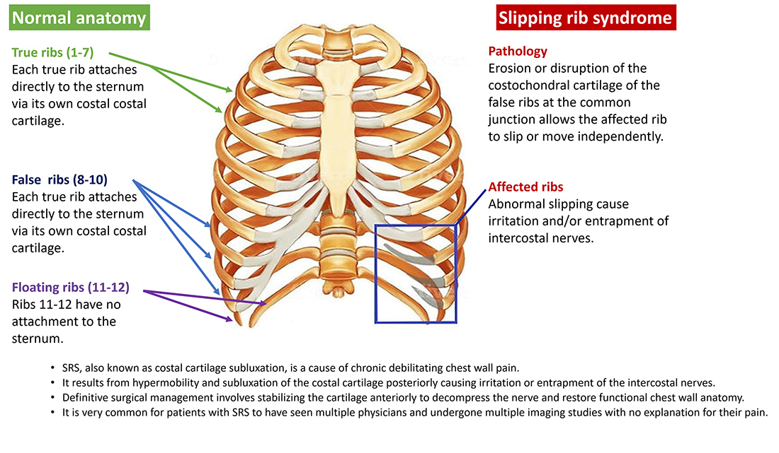 Diagram of the rib cage comparing normal rib anatomy with slipping rib syndrome, where lower ribs slip out of position and irritate nearby nerves.