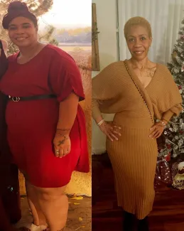 Before and After Bariatric Surgery Series