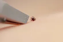A close-up of tweezers about to pinch a that is on someone's skin.